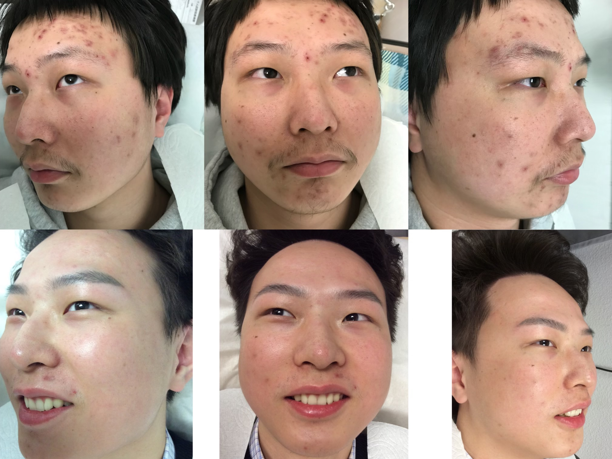 Patient acne transformation - before and after 6 months of treatment at Daisy MD Care