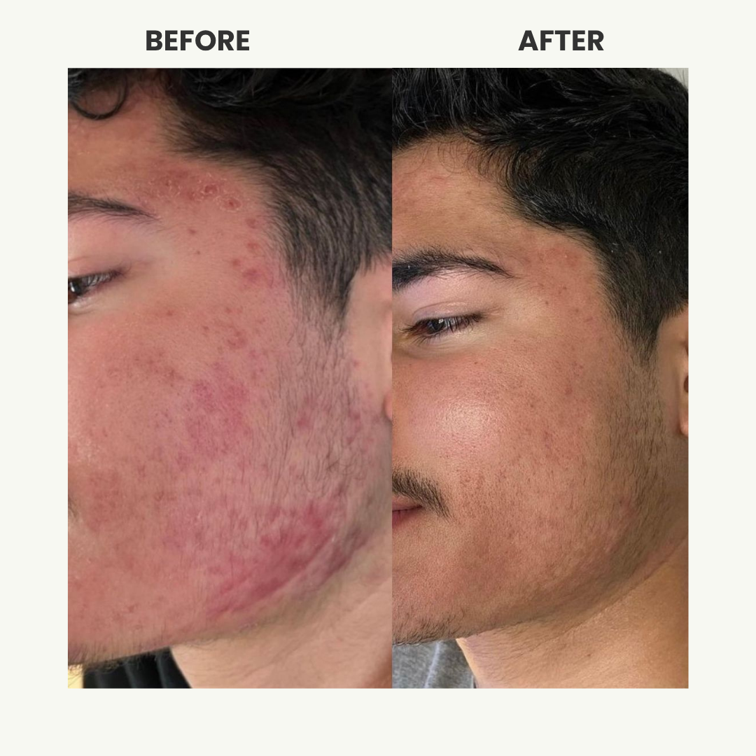 Acne treatment - before and after results