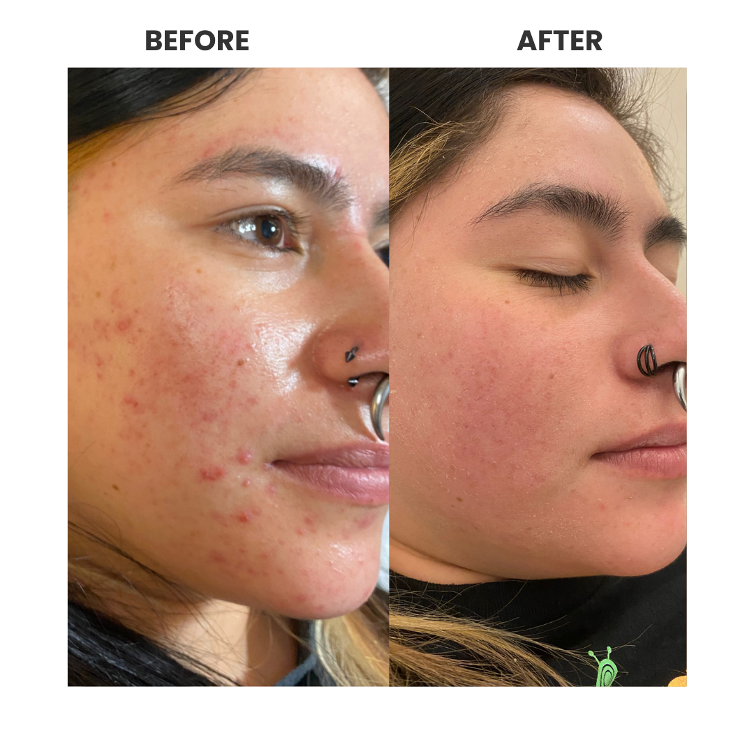 Professional facial treatment results