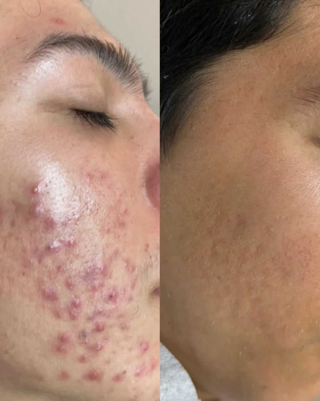 Advanced acne treatment results